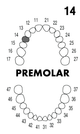PREMOLAR 1.4